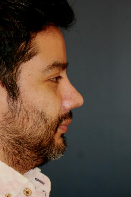 After image 2 Case #110236 - Male Open Rhinoplasty