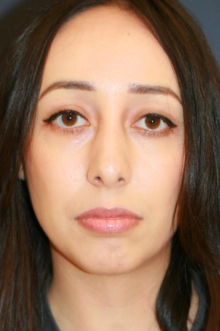 After image 1 Case #110166 - Female Rhinoplasty