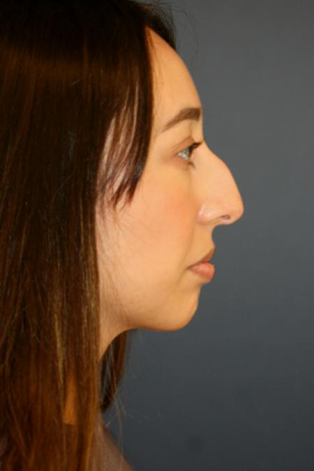 Before image 3 Case #110166 - Female Rhinoplasty