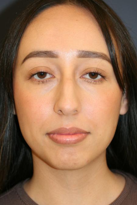Before image 1 Case #110166 - Female Rhinoplasty