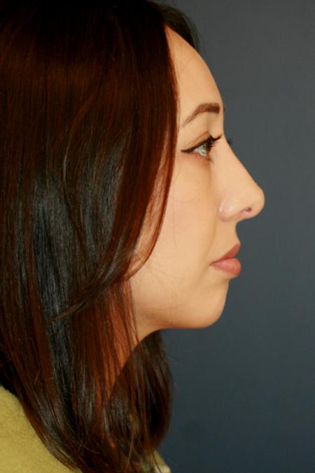After image 3 Case #110166 - Female Rhinoplasty