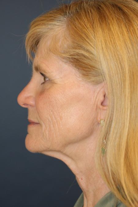 Before image 3 Case #111211 - Female Comprehensive Facial Rejuvenation