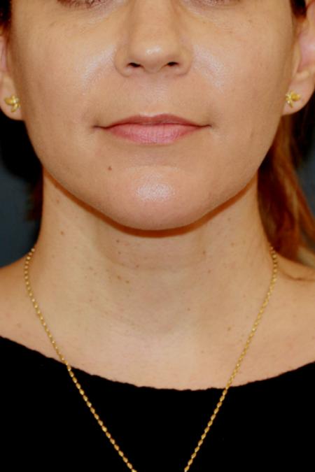 After image 1 Case #110356 - Female Necklift