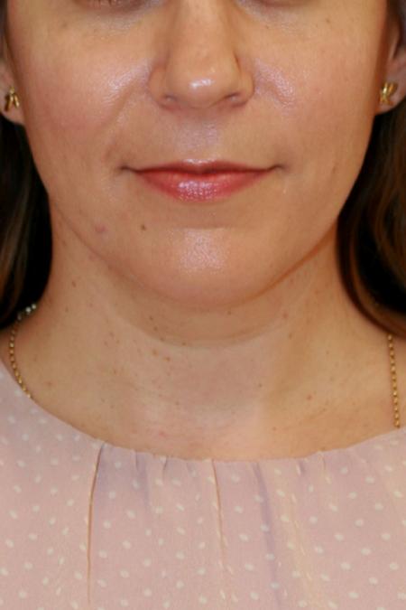 Before image 1 Case #110356 - Female Necklift