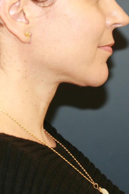 After image 3 Case #110356 - Female Necklift