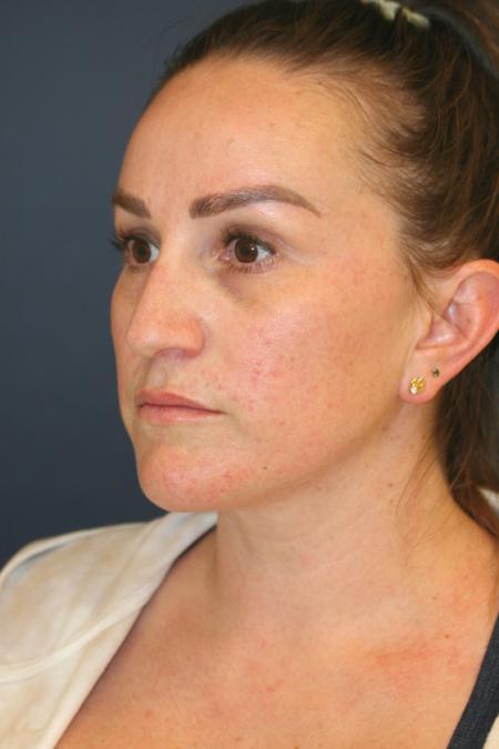 Before image 2 Case #110806 - Female Rhinoplasty