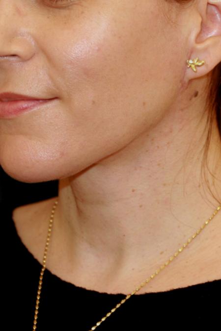 After image 2 Case #110356 - Female Necklift