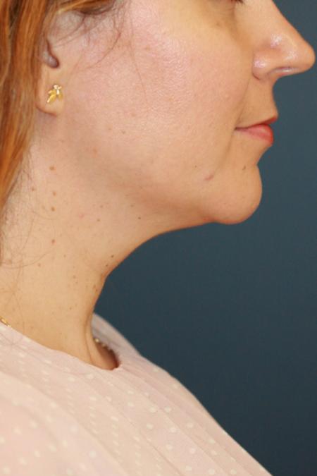 Before image 3 Case #110356 - Female Necklift