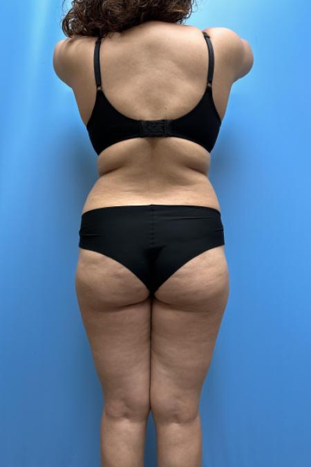 Before image 5 Case #110351 - Tummy Tuck, Lipo, Brazilian Butt Lift, Renuvion