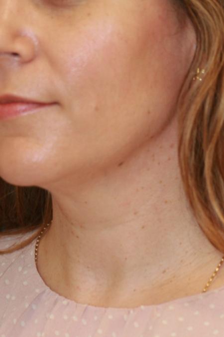 Before image 2 Case #110356 - Female Necklift