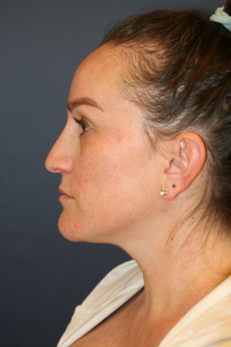 Before image 3 Case #110806 - Female Rhinoplasty