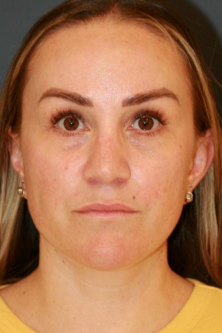 After image 1 Case #110806 - Female Rhinoplasty