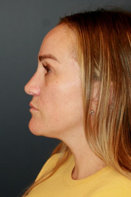 After image 3 Case #110806 - Female Rhinoplasty