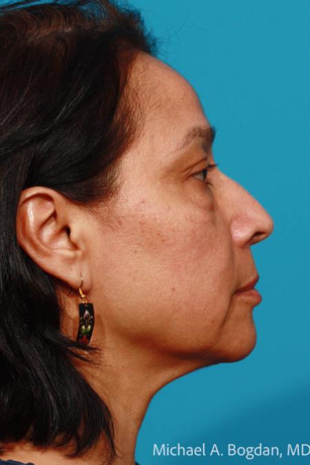 Before image 3 Case #111656 - Eyelid Procedure