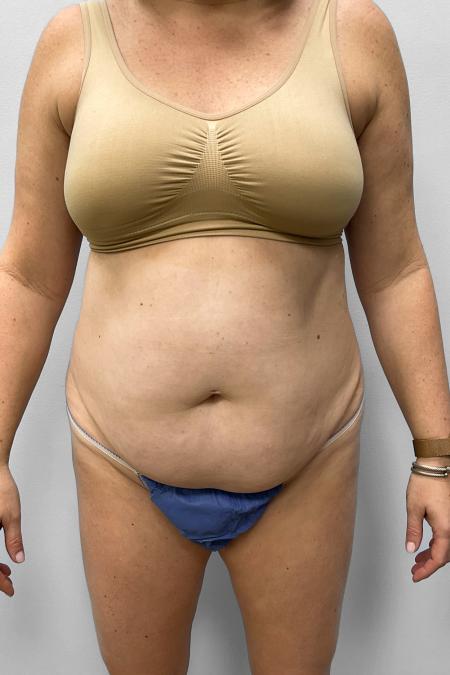 Before Case #111416 - Tummy Tuck with Liposuction