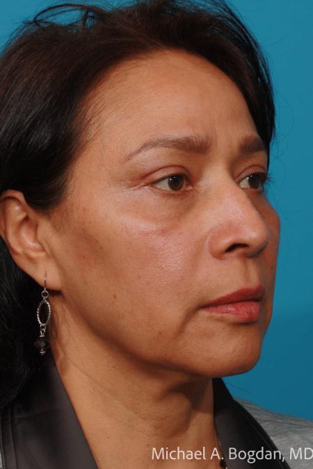 After image 2 Case #111656 - Eyelid Procedure