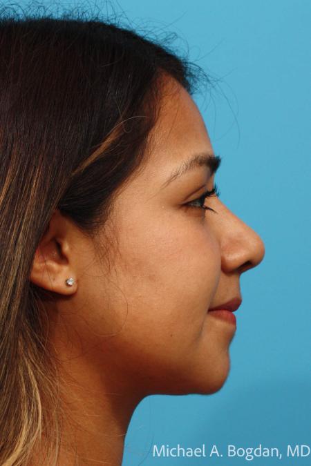 After image 3 Case #111896 - Rhinoplasty