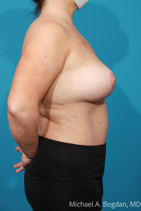 After image 3 Case #111811 - Mommy Makeover