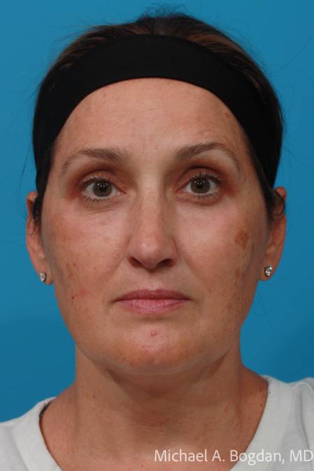 After image 1 Case #111751 - Blepharoplasty