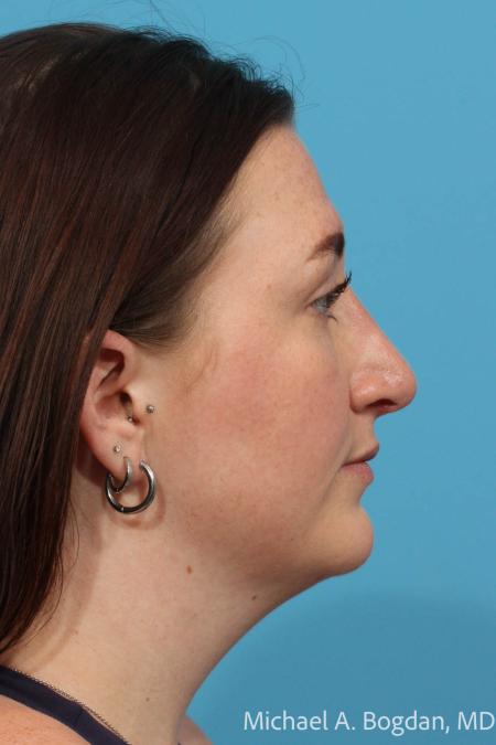 After image 3 Case #111771 - Rhinoplasty