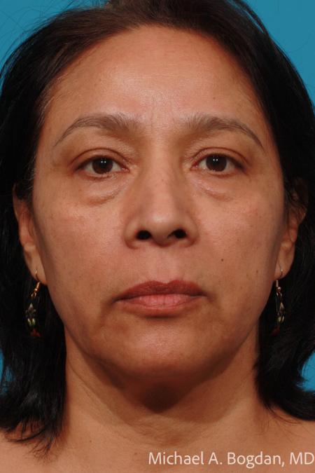 Before image 1 Case #111656 - Eyelid Procedure