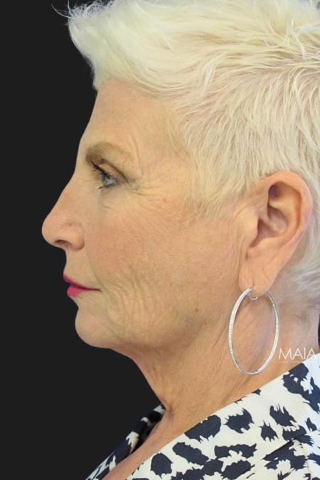 Before image 3 Case #111871 - 59 Year-Old Bride | Facial Rejuvenation