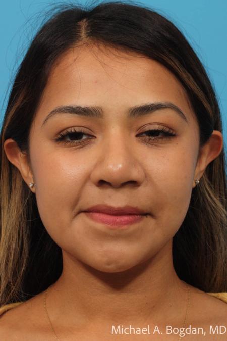 After image 1 Case #111896 - Rhinoplasty