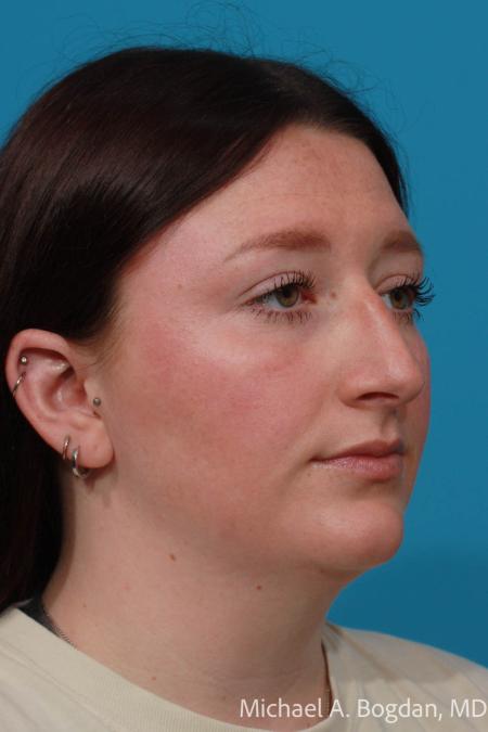 Before image 2 Case #111771 - Rhinoplasty