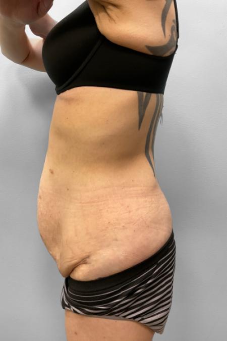 Before image 3 Case #111396 - Abdominoplasty & Liposuction