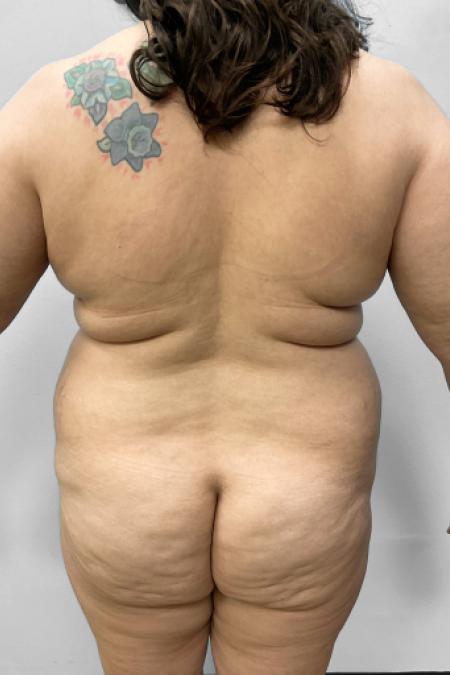 Before Case #111436 - BBL, Tummy Tucky & Lipo