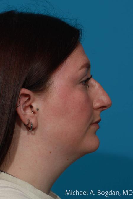 Before image 3 Case #111771 - Rhinoplasty