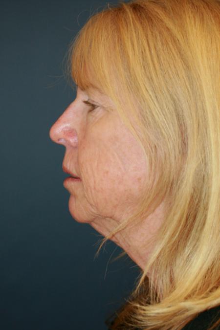 Before image 3 Case #111621 - Female Comprehensive Facial Rejuvenation