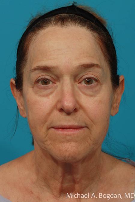 Before image 1 Case #111911 - Face Lift