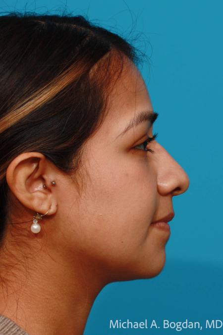 Before image 3 Case #111896 - Rhinoplasty