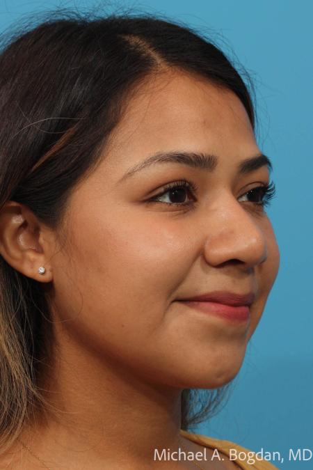 After image 2 Case #111896 - Rhinoplasty
