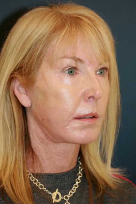 After image 2 Case #111621 - Female Comprehensive Facial Rejuvenation
