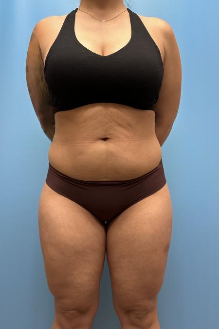 Before image 1 Case #111606 - Liposuction body and thighs with Renuvion