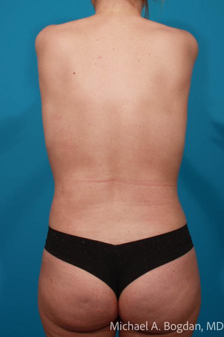 After image 5 Case #111816 - Mommy Makeover