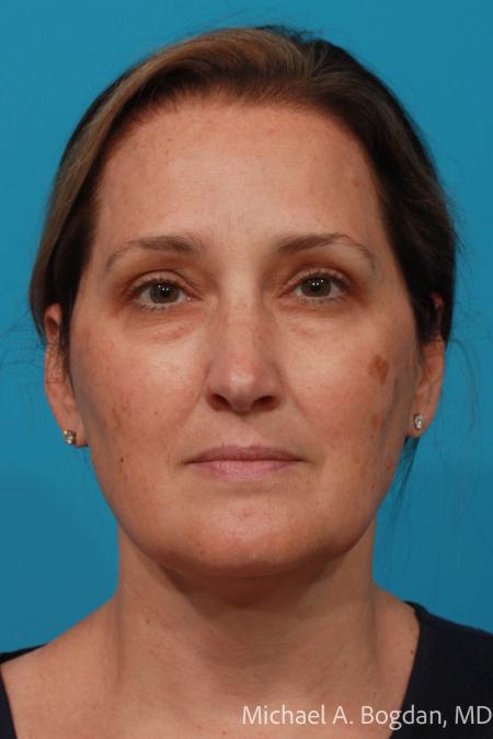 Before image 1 Case #111751 - Blepharoplasty