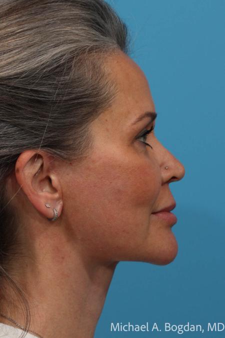 After image 3 Case #111561 - Face Lift and blepharoplasty