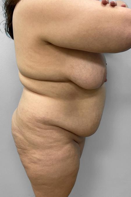 Before Case #111436 - BBL, Tummy Tucky & Lipo