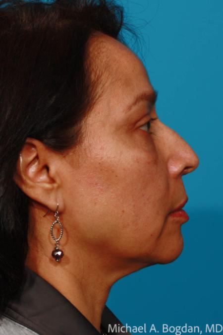 After image 3 Case #111656 - Eyelid Procedure