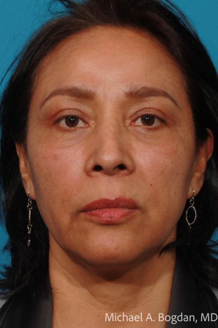 After image 1 Case #111656 - Eyelid Procedure