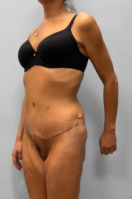 After image 2 Case #111396 - Abdominoplasty & Liposuction
