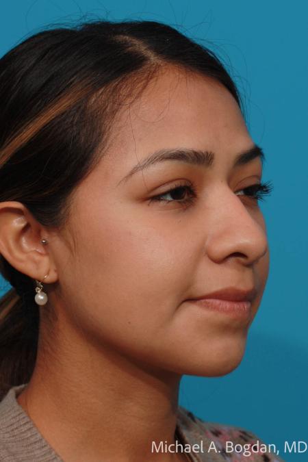 Before image 2 Case #111896 - Rhinoplasty
