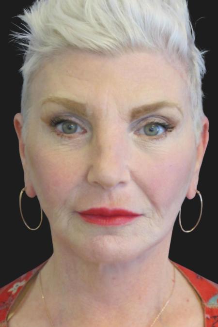 After image 1 Case #111871 - 59 Year-Old Bride | Facial Rejuvenation