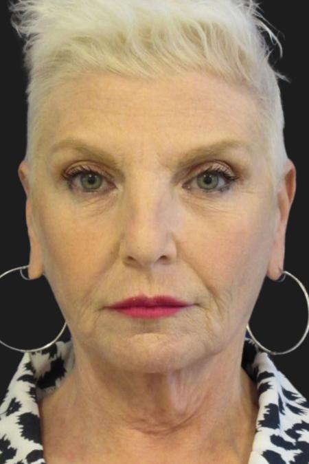 Before image 1 Case #111871 - 59 Year-Old Bride | Facial Rejuvenation