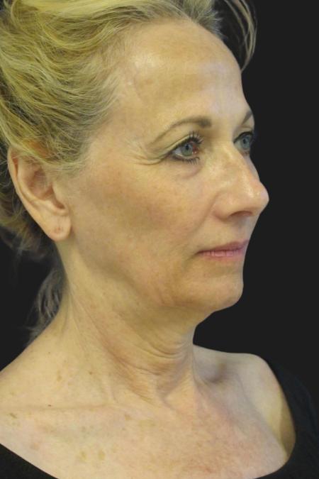 Before Case #109806 - 67 year-old before and after facial rejuvenation
