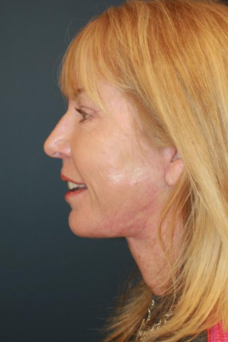 After image 3 Case #111621 - Female Comprehensive Facial Rejuvenation