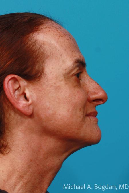 Before image 3 Case #111961 - Face lift